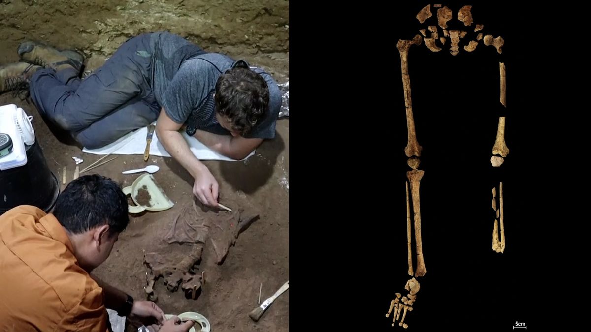 K nejstarší chirurgické amputaci došlo před 31 000 lety na Borneu. Pacient přežil
